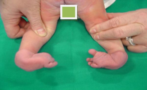 foto fig.n. 1bis piedi torti congeniti