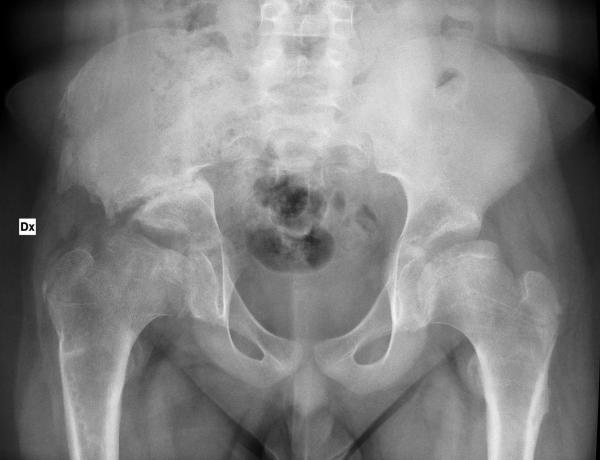 Figura 1: Paziente di anni 10, osteotomia di Chiari a destra per esiti di m. di Perthes. La dislocazione mediale dell’acetabolo comporta una riduzione del diametro traverso dello stretto superiore, che si accentua ulteriormente in caso di bilateralità del trattamento.